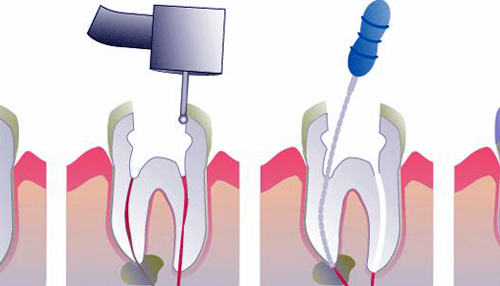 otros tratamientos endodoncia