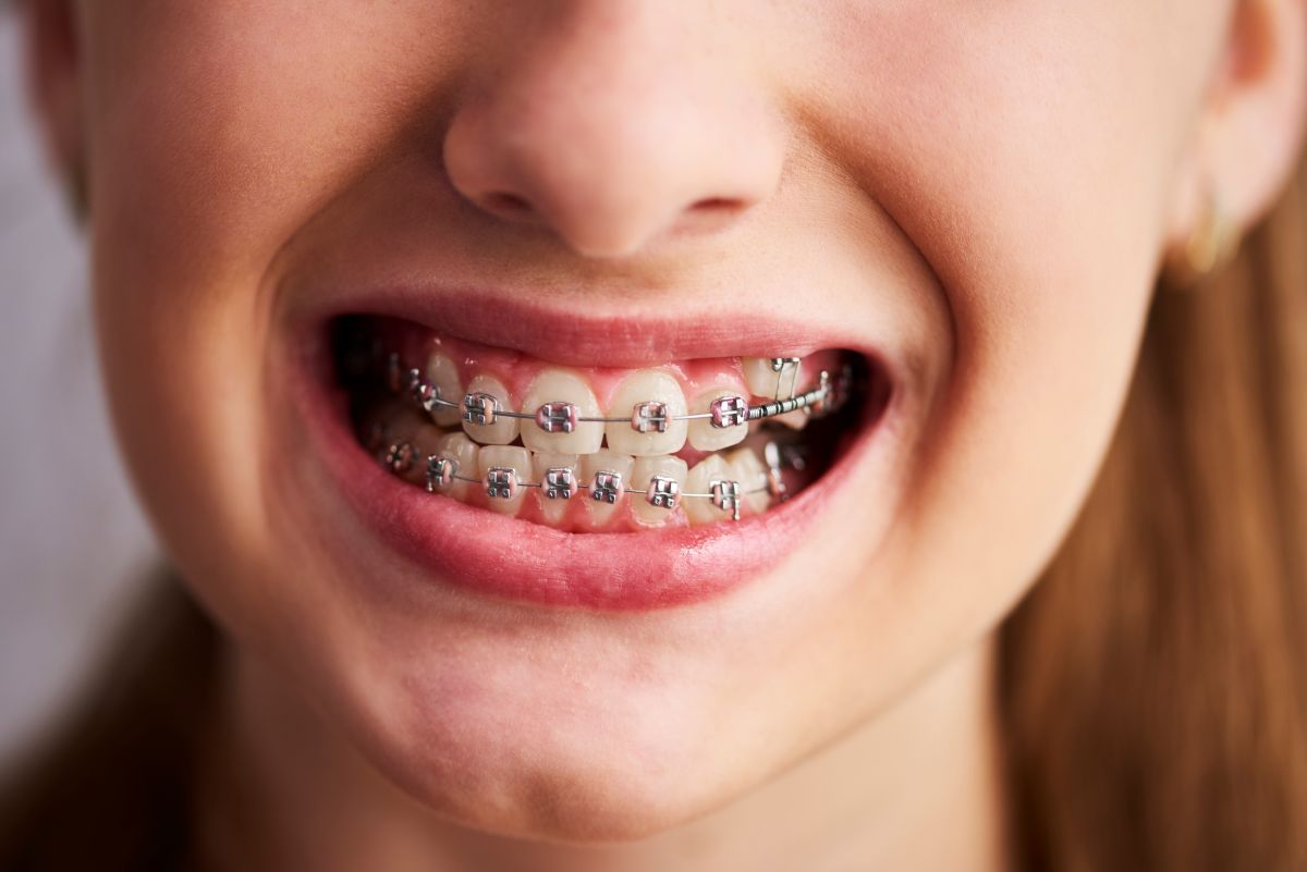 brackets metalicos y ceramicos