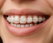 brackets de ceramica o zafiro