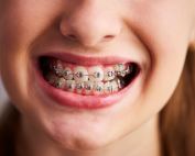 brackets metalicos y ceramicos