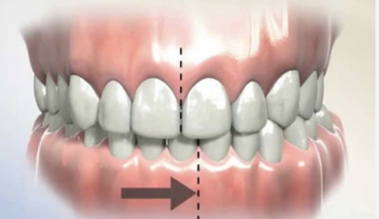 Cuando los dientes no coinciden con el centro de la cara: qué significa una línea media desviada