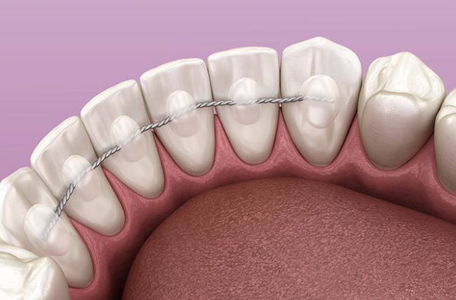 Retenedores dentales: por qué la estabilidad empieza cuando termina la ortodoncia