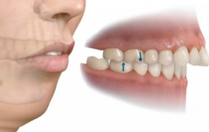 ¿Por qué los dientes de arriba sobresalen demasiado respecto a los de abajo?